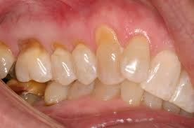 چه چیزی موجب آسیب به مینای دندان می‌شود؟