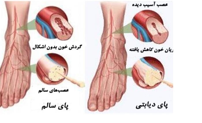 نکاتی برای حفظ گردش خون در پای افراد دیابتی