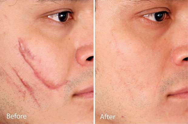 بهترین راهکارها برای پنهان کردن جای زخم در پوست صورت