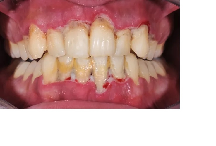 چگونه از تجمع کلسیم روی دندان جلوگیری کنیم؟