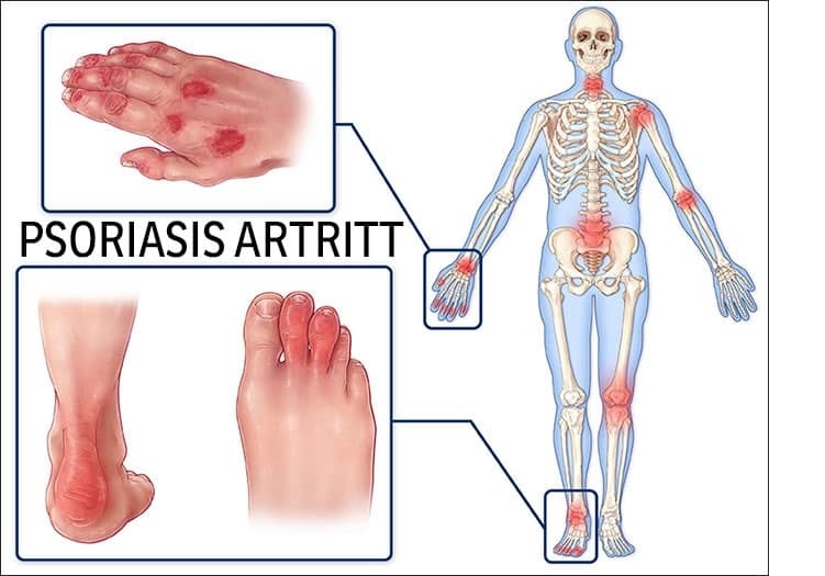 چه چیزی آرتریت پسوریاتیک را بدتر می‌کند؟