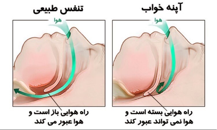 درمان آپنه خواب