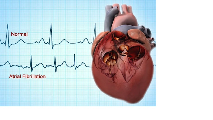 نکاتی برای زندگی با فیبریلاسیون دهلیزی