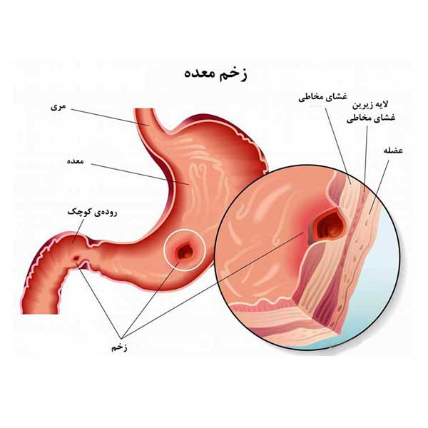 مفیدترین و مضرترین غذاها برای زخم‌معده