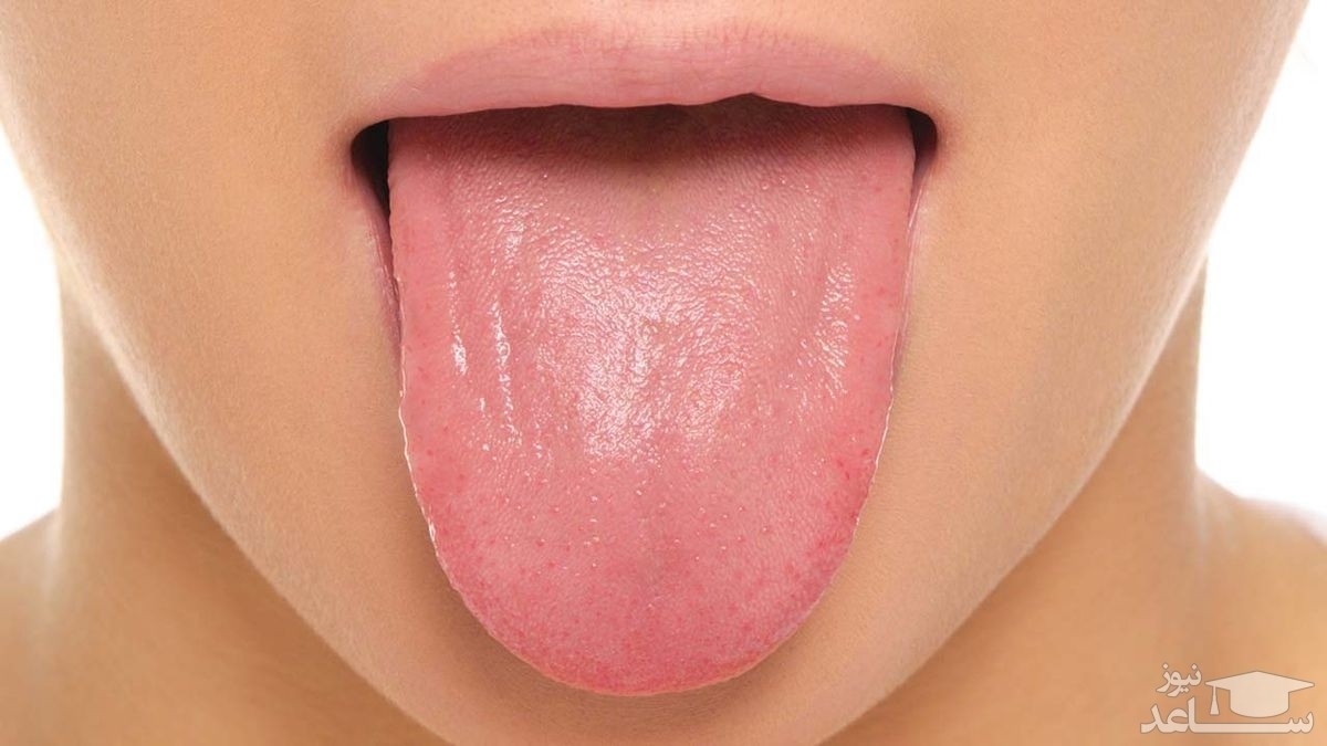 سندرم سوزش دهان