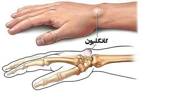 درباره کیست گانگلیون