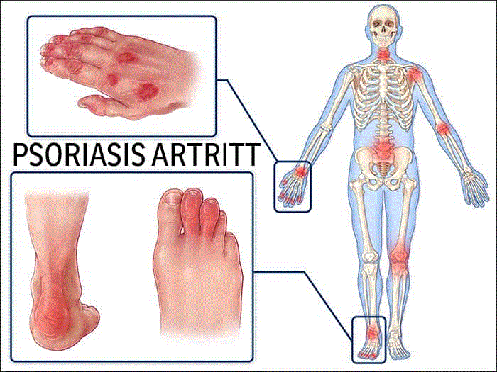 آرتریت پسوریاتیک چگونه روی پاها تاثیر می‌گذارد؟