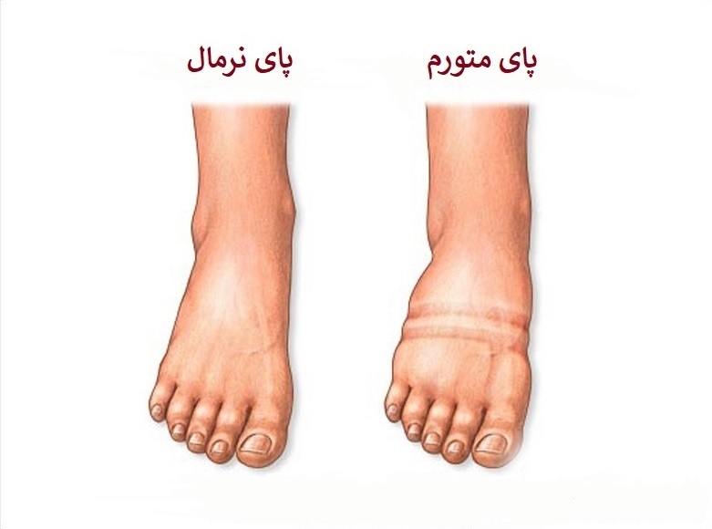 علل پا و مچ پای متورم