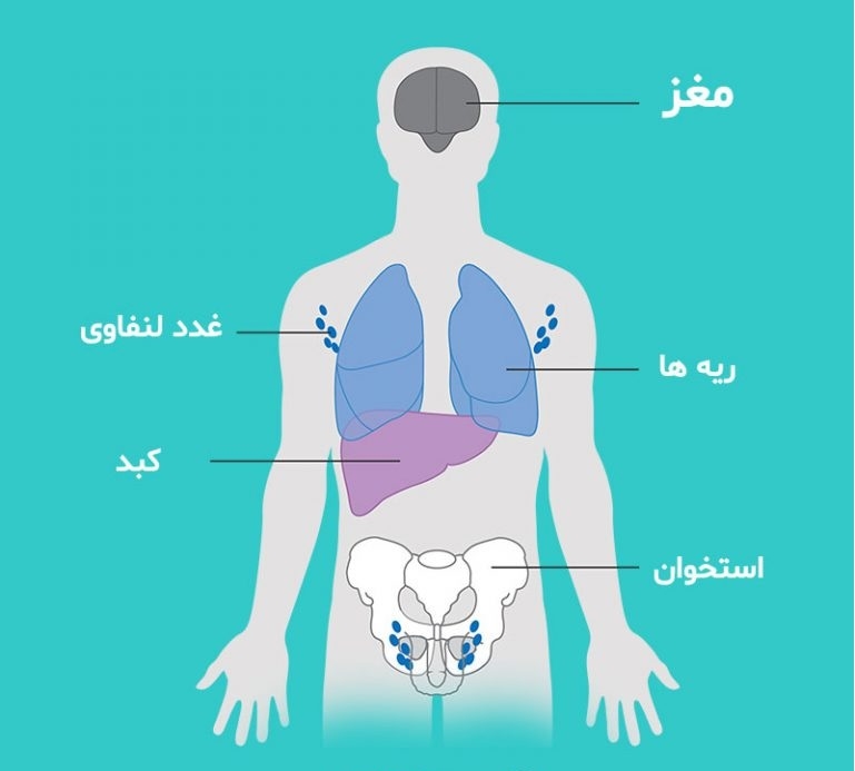 سرطان پستان تا کجا گسترش می‌یابد؟
