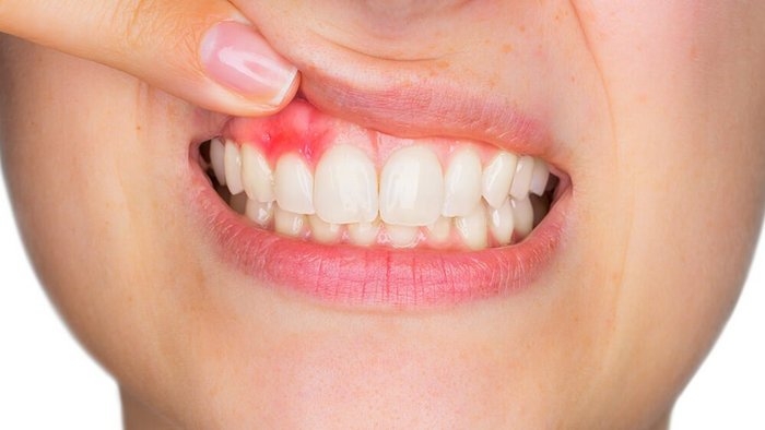 «پریودنتیت» چیست؟