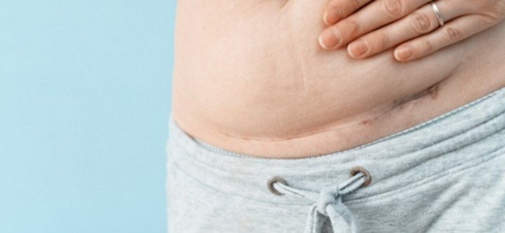 علائم اندومتریوز بعد از سزارین چیست؟