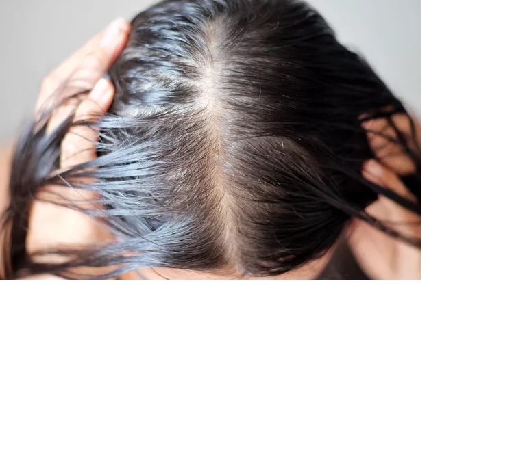 آیا ریزش مو در یائسگی طبیعی است؟