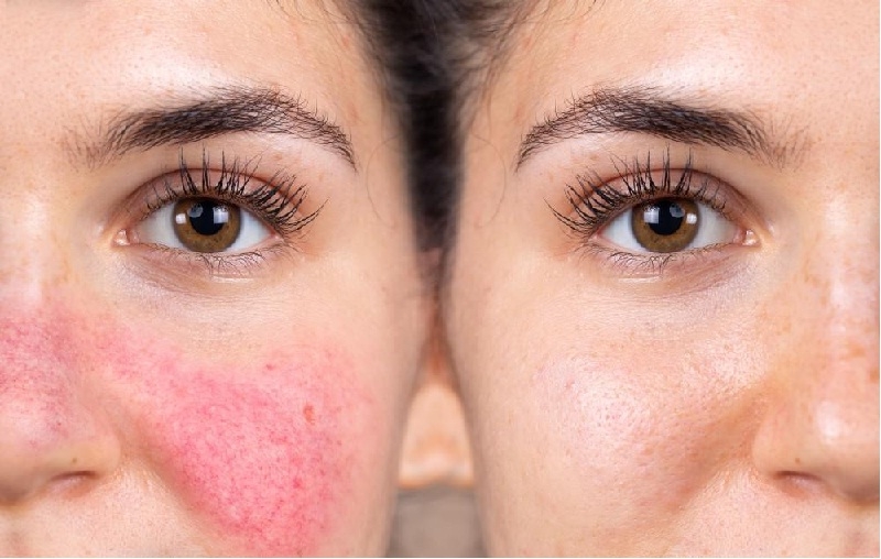 چگونه در هوای گرم با شعله‌ور شدن روزاسه مقابله کنیم؟