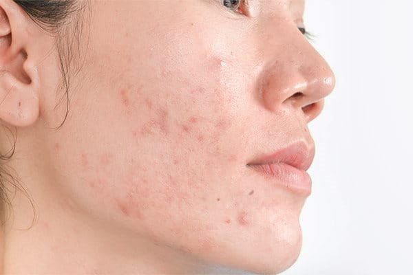 آیا آفتاب‌سوختگی می‌تواند بر آکنه تاثیرگذار باشد؟