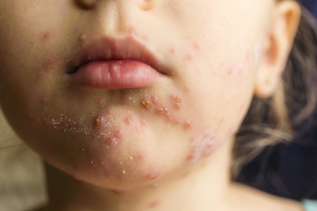 10 نوع رایج بثورات پوستی و علائم آن‌ها
