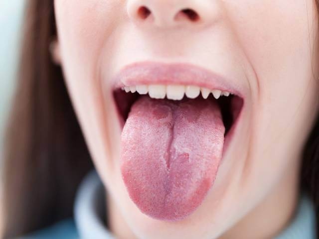 التهاب زبان یا گلوسیت چیست؟
