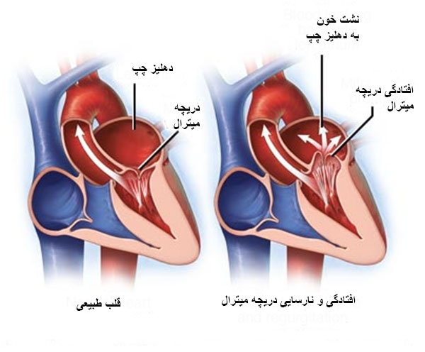 افتادگی دریچه میترال چیست و چگونه درمان می‌شود؟