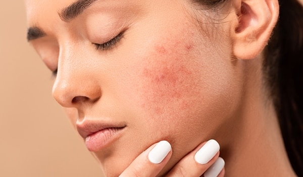 چطور پوست تحریک‌شده و ملتهب را به حالت عادی بازگردانیم؟