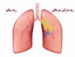 علائم مرحله 1 سرطان ریه