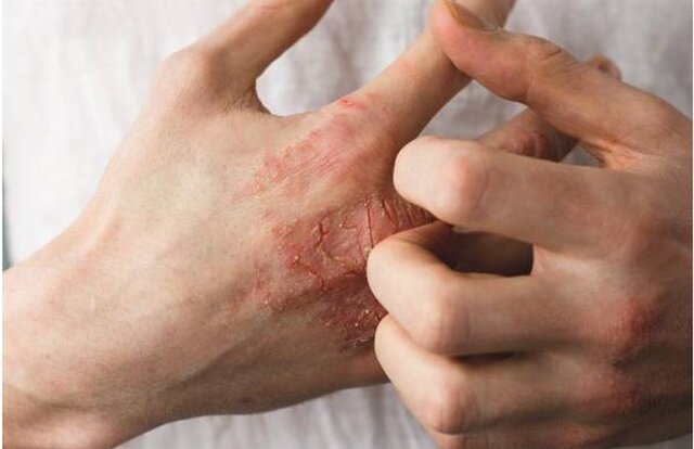 ۷ ماده غذایی برای مقابله با خشکی پوست در فصول سرد