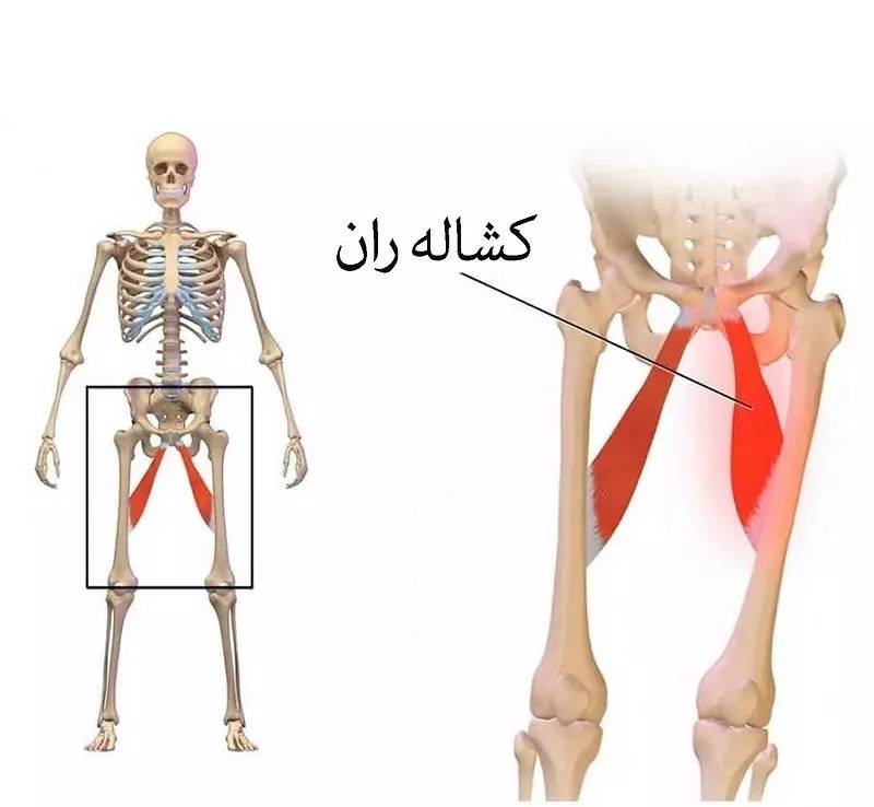 علل کمردرد در کودکان