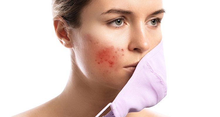 ماسکنه یا آکنه ماسک: چه باید کرد؟