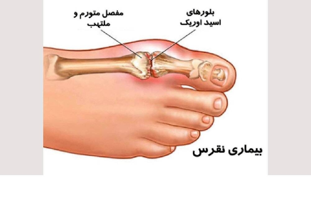 درد نقرس چگونه است؟