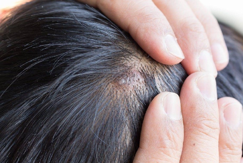 چگونه آکنه پوست سر را درمان کنیم؟