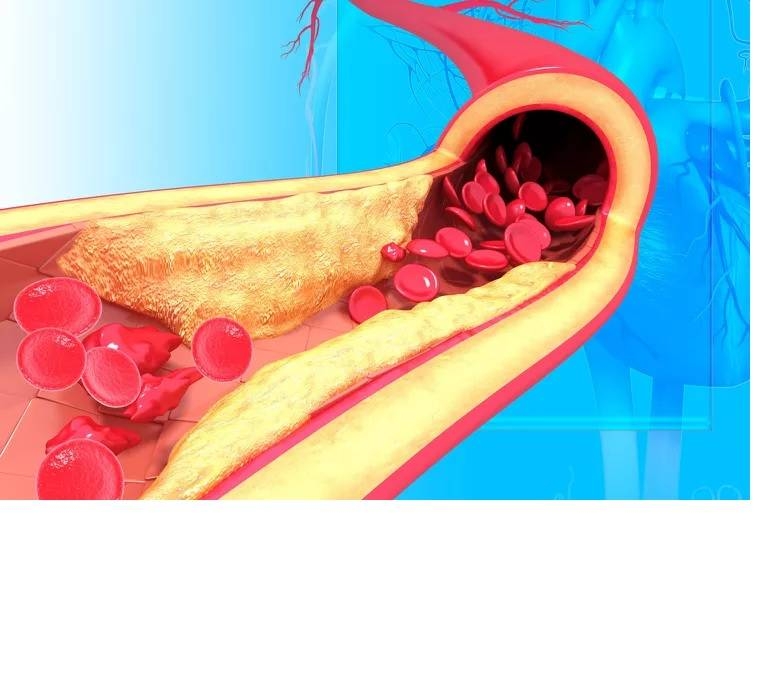 آپولیپوپروتئین بی(apoB)چیست و در مورد خطر بیماری قلبی چه اطلاعاتی می‌دهد؟