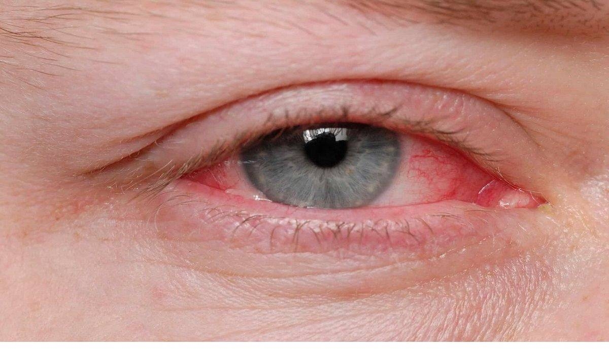 قرمزی چشم ناشی از التهاب ملتحمه تا چه زمانی مسری است؟