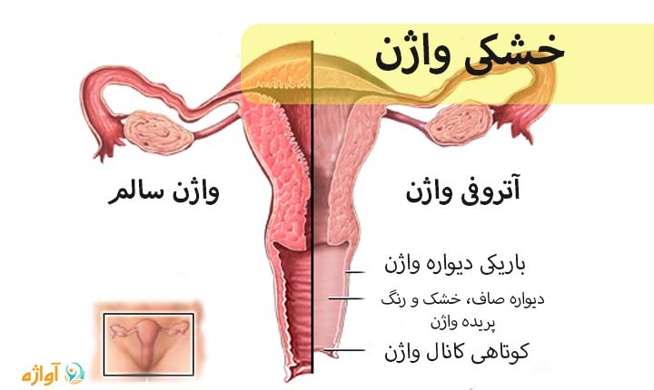 خشکی واژن چیست؟چه علائمی داشته و چگونه درمان می‌شود؟