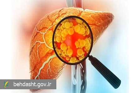 زندگی ماشینی و کم تحرکی، عامل ابتلا به کبد چرب