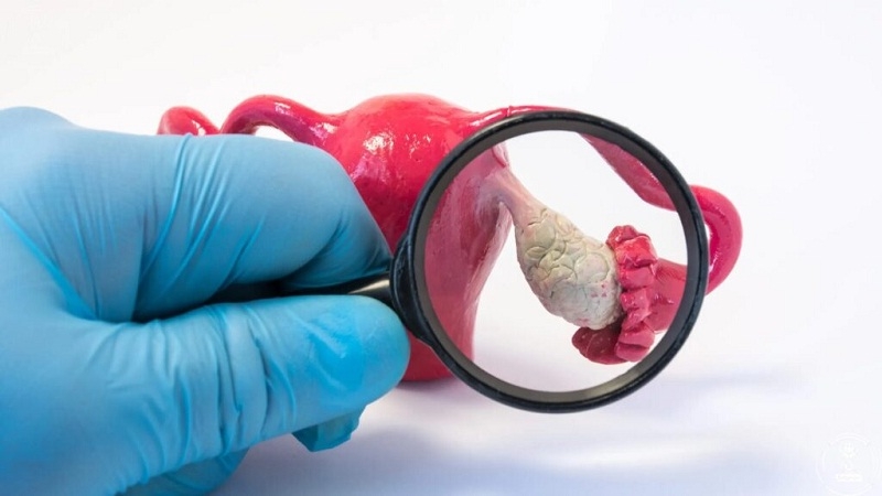 تنبلی تخمدان، یکی از شایع‌ترین علل ناباروری زنان است