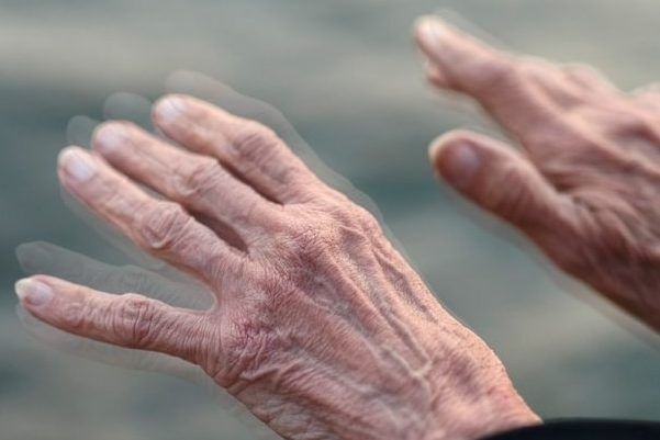 ابتلا به پارکینسون در ایران ۴۰درصد بیشتر از میانگین جهانی