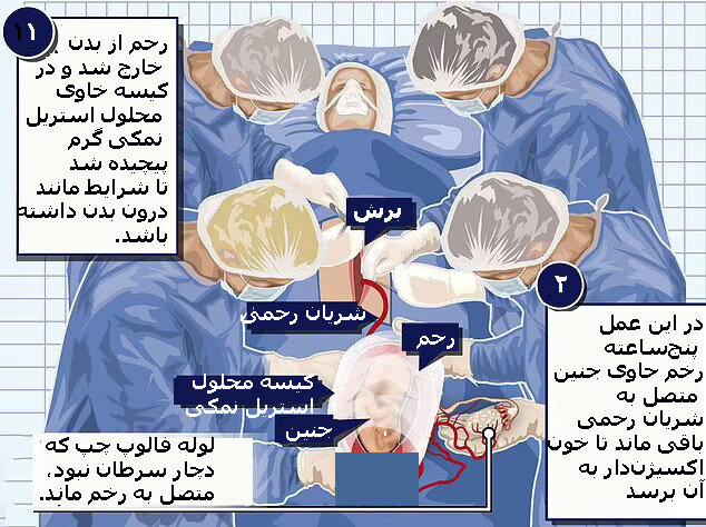 یک معجزه پزشکی: نوزادی در انگلیس دو بار متولد شد