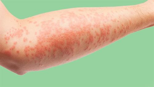 درماتیت آتوپیک؛ حساسیت پوستی مزمن و آزاردهنده