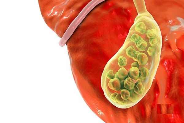 سنگ کیسه صفرا چه علائمی دارد؟ 
