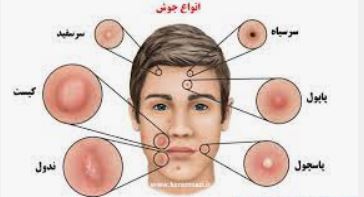 بهترین آنتی بیوتیک برای جوش صورت 
