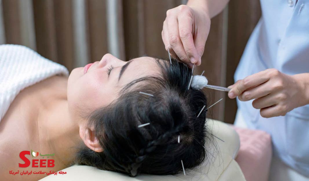 کاربرد طب سوزنی کف سر در درمان برخی از بیماری های عصبی