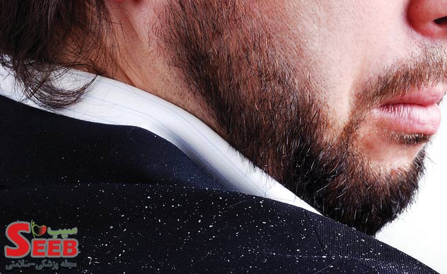 شوره سر چیست و چگونه آن را از بین ببریم؟