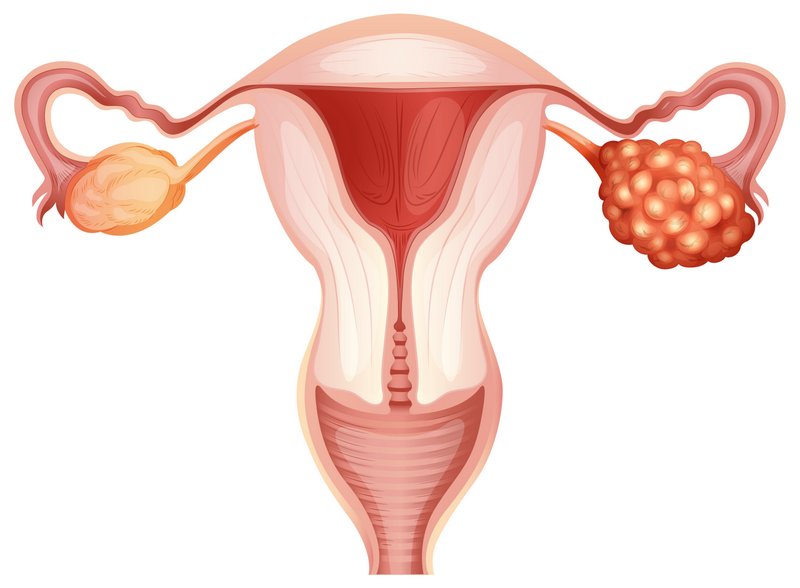 سرطان تخمدان OVARIAN CANCER
