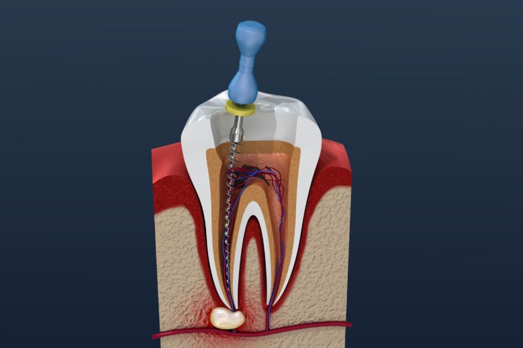 درمان ریشه دندان &#8211; Root Canal Therapy