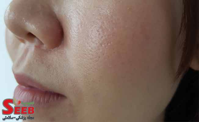 پوست چرب چیست؟ بهترین راه جلوگیری از چرب شدن پوست
