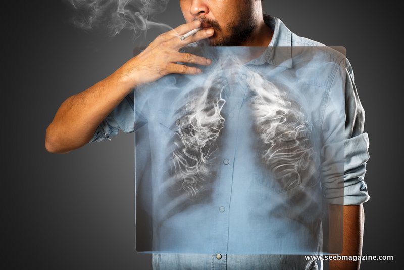 سرطان ریه (LUNG CANCER)