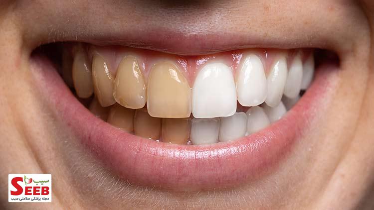 چرا دندان‌ها زرد می‌شوند؟