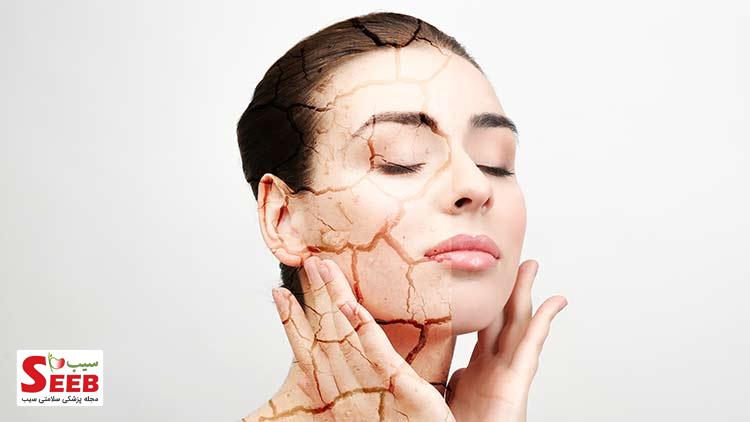 چرا پوست خشک می‌شود و درمانش چیست؟