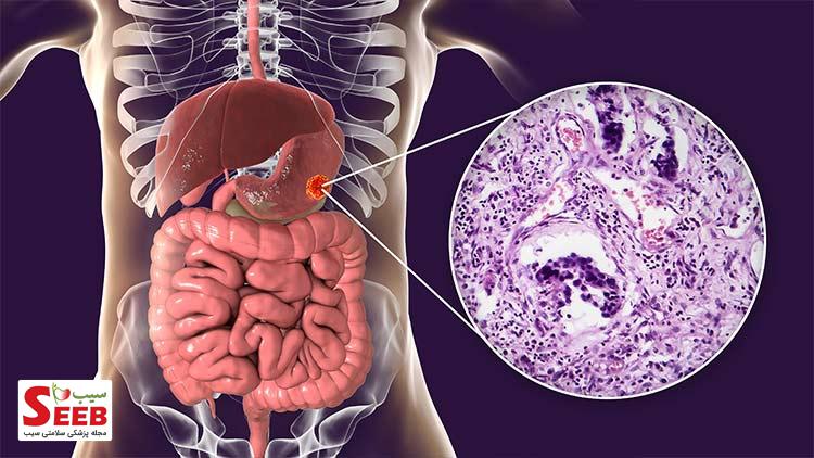 سرطان معده چیست و چگونه می‌توان از آن جلوگیری کرد؟