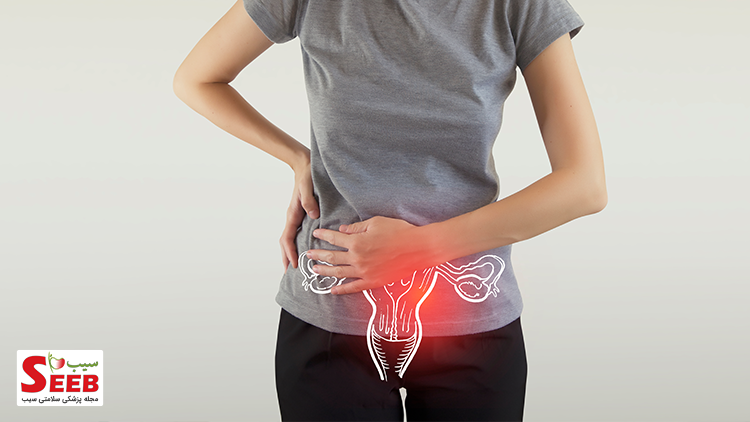 سرطان تخمدان OVARIAN CANCER